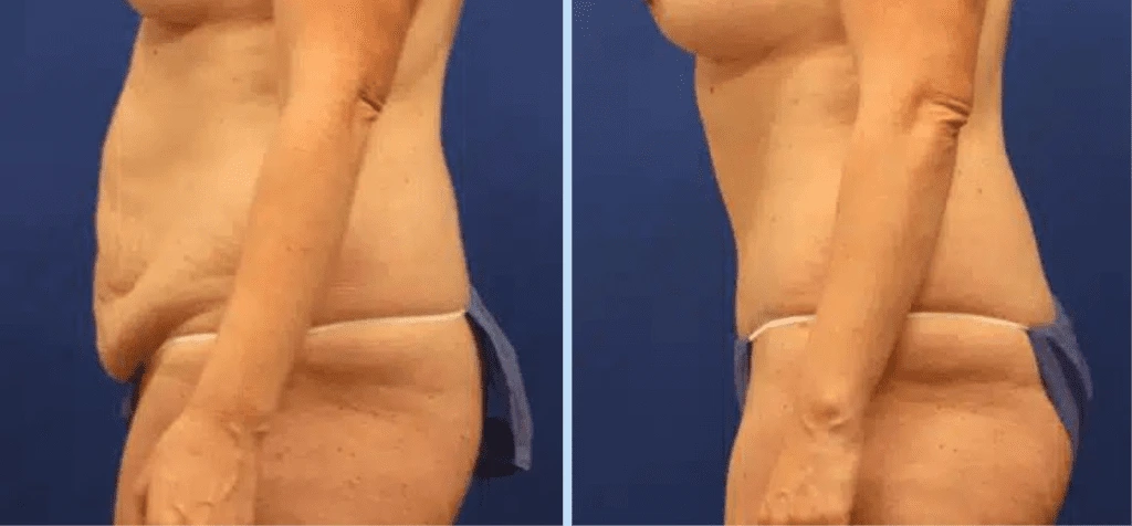 Mommy Makeover Before & After Photos - Case 1 Banner