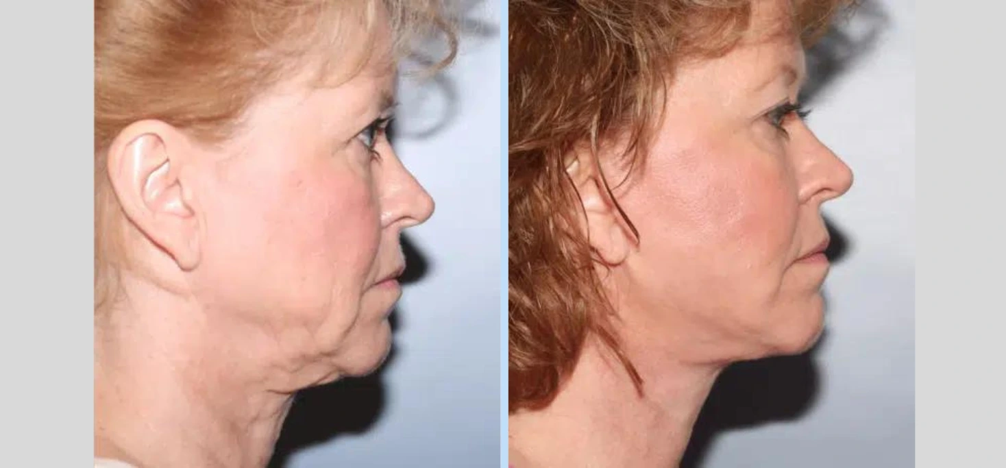 Neck Lift Before & After - Case 1