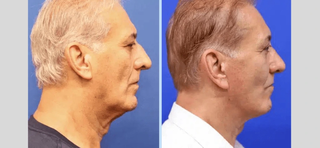 Neck Lift Before & After - Case 3