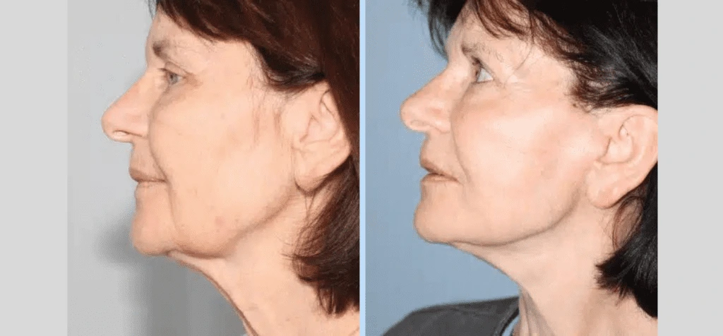Neck Lift Before & After - Case 4