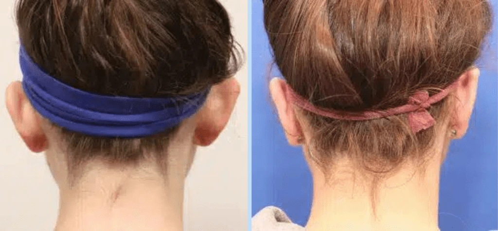 Otoplasty Before & After - Case 1