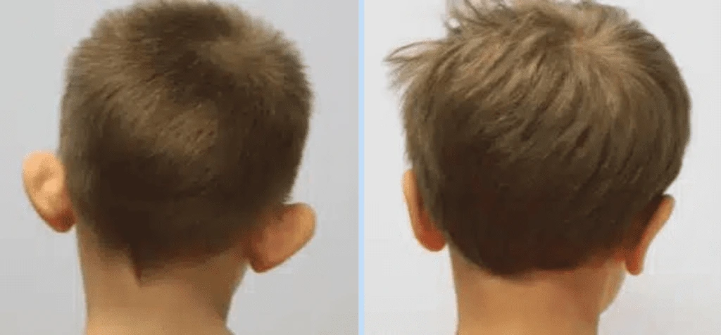 Otoplasty Before & After - Case 3