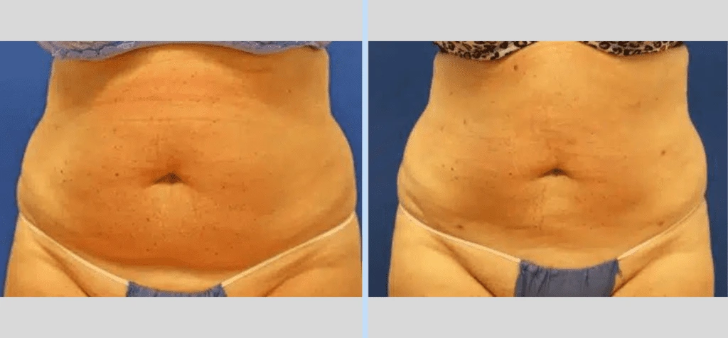 SmartLipo Before & After - Case 2 Banner