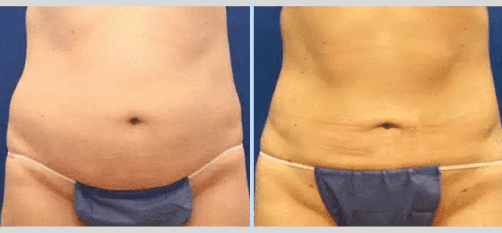 SmartLipo Before & After - Case 3 Banner