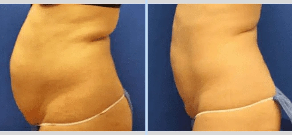SmartLipo Before & After - Case 4 Banner