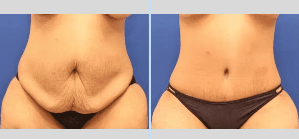 Tummy Tuck Before & After – Case 3 Banner