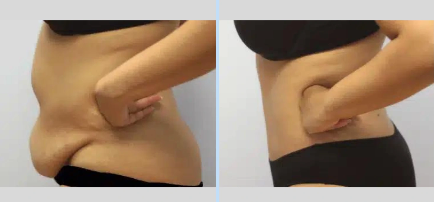 Tummy Tuck Before & After – Case 4 Banner