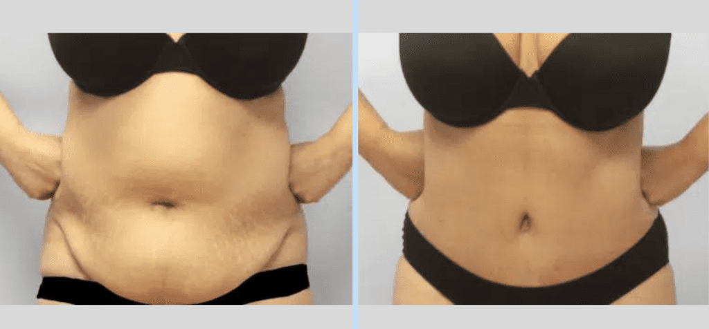 Tummy Tuck Before & After – Case 4 Banner