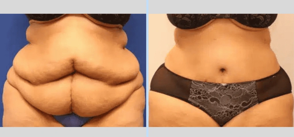 Tummy Tuck Before & After – Case 5 Banner