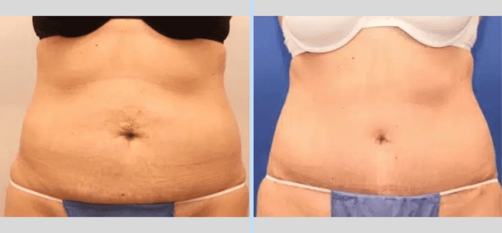 Tummy Tuck Before & After – Case 6 Banner