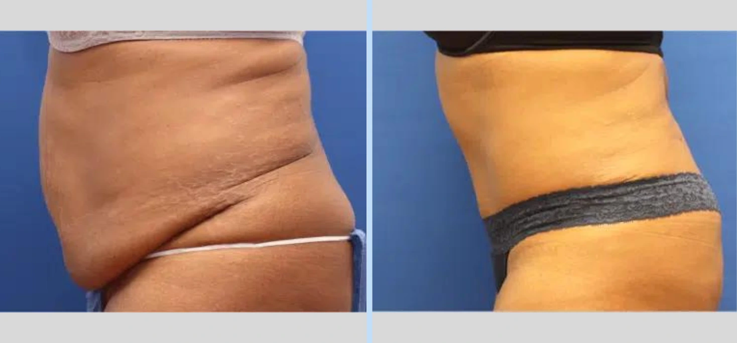 Tummy Tuck Before & After – Case 7 Banner