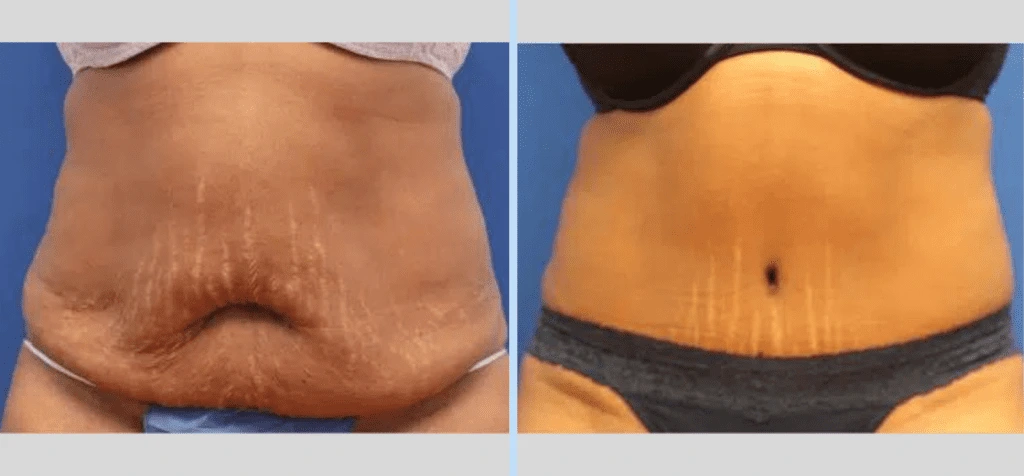 Tummy Tuck Before & After – Case 7 Banner