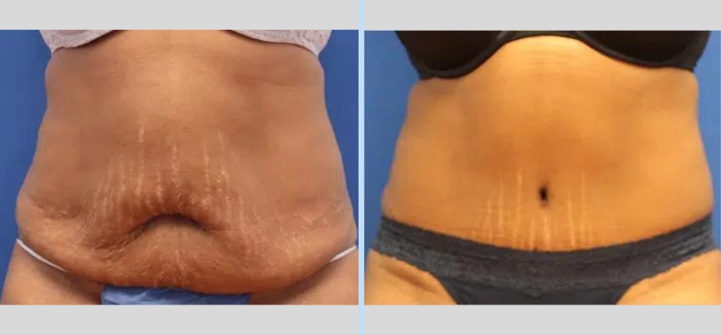 Tummy Tuck Before & After – Case 7 Banner