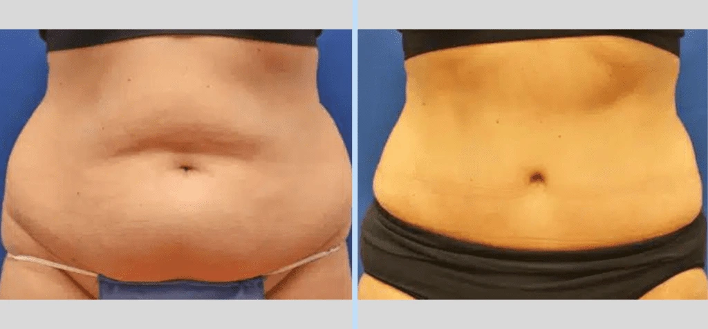 Tummy Tuck Before & After – Case 8 Banner
