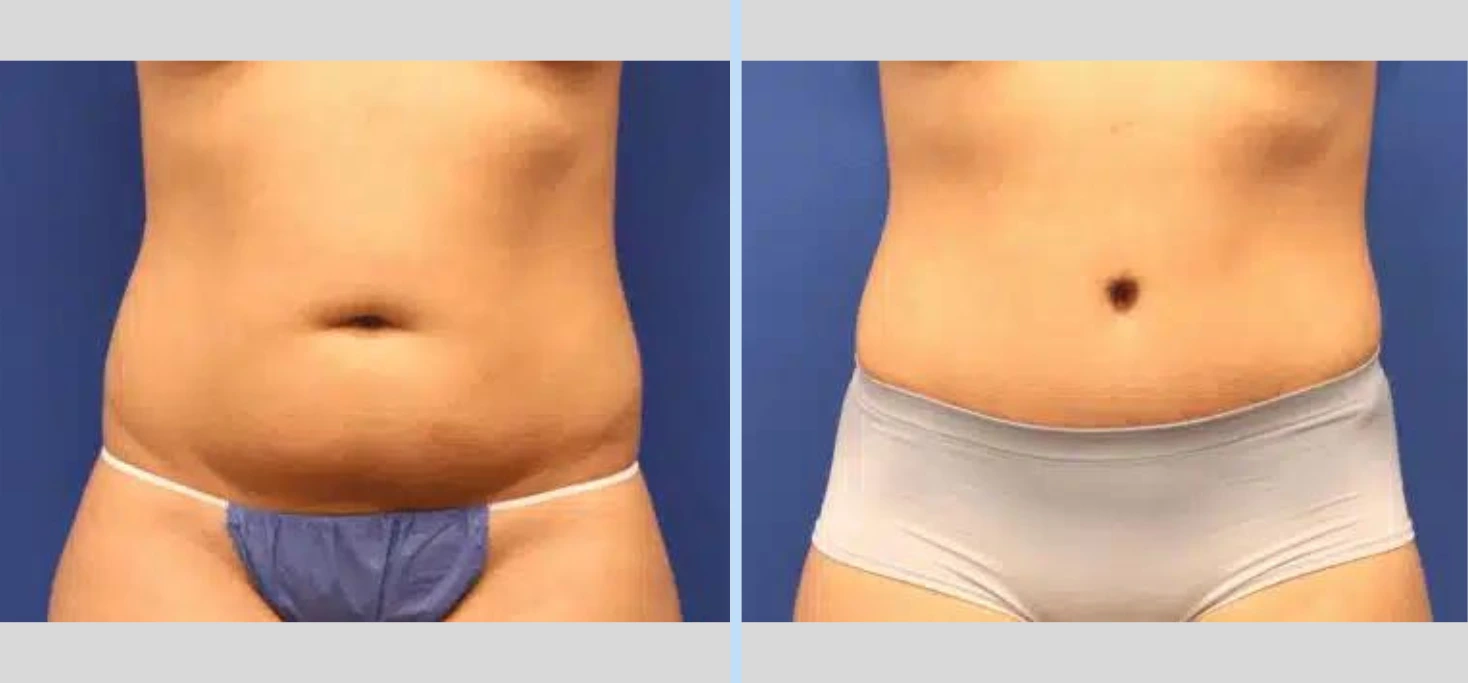 Tummy Tuck Before & After – Case 9 Banner