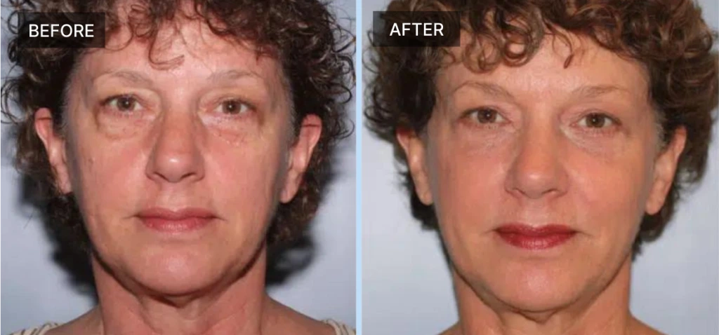 Facelift Before & After Banner